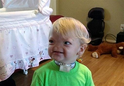 پسر بدون دماغ در دو سالگی درگذشت + عکس