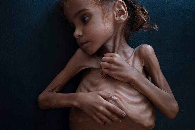 مرگ دختر یمنی که تصویرش جهان را تکان داد +عکس