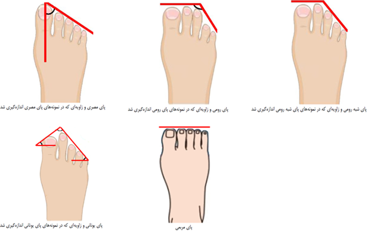 پای ایرانیان چه شکلی است؟ + عکس