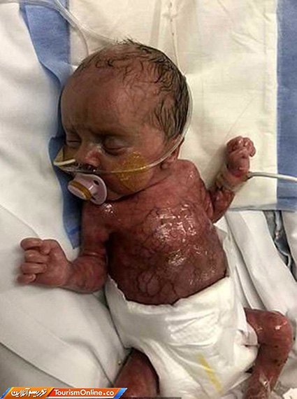 تولد نوزاد بدون پوست در بیمارستان ناتینگهام/ تصاویر