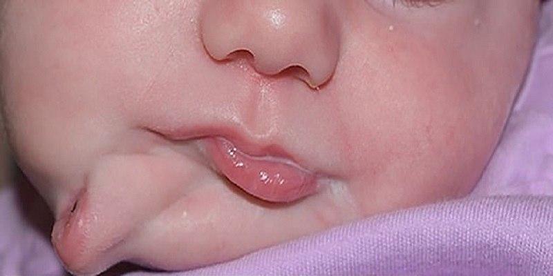 تولد نوزادی با دو دهان در آمریکا + تصویر